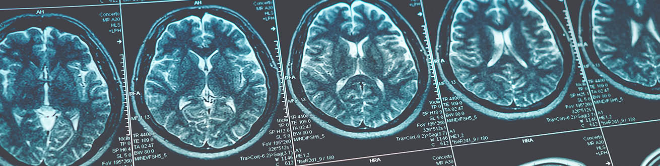 traumatic brain injury attorney